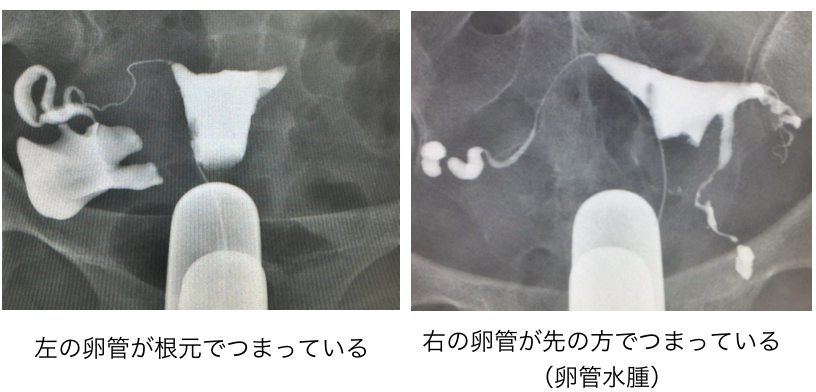 通 水 検査 卵 管 造影 どっち が 痛い